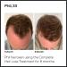 Sons Minoxidil 5% Hair Regrowth Solution for Men - Precision Application System - 1 Month Supply - Buy Online on GoSupps.com