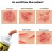 BSMAX 5PCS Natural Chinese Herbal Eczema Psoriasis Creams for Dermatitis & Pruritus - Psoriasis Ointment - Buy Online on GoSupps.com