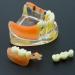 Dental Implant Restoration Teeth Model Removable Bridge Denture Demo for Teaching Study and Patient Education