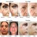 Eye RF Anti Aging Device | Reduce Eye Bags, Puffiness, Dark Circles | Home Radio Frequency Beauty Instrument for Eyes - Buy Online on GoSupps.com