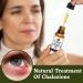 Chalazion Remover & Stye Eye Treatment - USA Made (15ml) - Buy Online on GoSupps.com