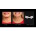 NeckTITE Magic - Instant Neck Lift (2 pack) 12 Count x 2 - Shop Now! - Buy Online on GoSupps.com