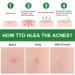 CGify Acne Pimple Patch 24 Patch * 5 Pack - Hydrocolloid Acne Spot Treatment Sticker for Healing Acne, Zits, and Blemishes - Buy Online on GoSupps.com