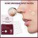 Acne Dressing Spot Patch Acne Paste Transparent Pimple Patch Breathable Painless Acne Treatment Gel Patch Skin Care Absorb Pus Rapid Healing Effective Antibacterial Protection 36 Patches - Buy Online on GoSupps.com
