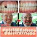 KEDEJIN 28pcs Resin Tooth Model - Durable Dentures & Ergonomic Universal False Teeth for Dental Education - Buy Online on GoSupps.com
