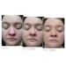 Sonage Zitlox Salicylic Acne Gel - Effective Spot Treatment with Tea Tree Oil | Clear Blemishes & Benzoyl Peroxide Alternative | International Shipping Available - Buy Online on GoSupps.com