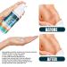 YoNGBAO Scar Removal Cream: Natural Extract, Brightens Skin, Improves Surgical Scars - Buy Online on GoSupps.com