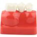 Implant Model Resin Dental Demonstration Demonstration Tooth Model Teeth Model Science Homework for Teaching Model School Dentist - Buy Online on GoSupps.com