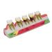 Model of dental parodontitis different stages tooth parodontitis ad model for communication and clarification of dentists and patients