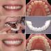 Fluktrix 4-Piece Clip-In Silicone Teeth - Cosmetic Prostheses for Instant Smile Makeover - Buy Online on GoSupps.com