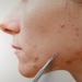 Suvorna Skinpal S90 - Professional Blackhead and Acne Remover Tool with Surgical Steel for Clear Skin - Buy Online on GoSupps.com