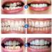 Xiaocui 5pcs Comfort Fit Dentures | Cosmetic Veneers for Whiter Teeth | Best Affordable Dental Prosthesis - Buy Online on GoSupps.com