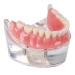 Dental Upper Implantate Model - Upper Overdenture Restoration Model - With superior teeth demo transparent vision soft gum implant nail for education and study model (c)