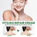 Finxenow TreatVitiligo Soothing Cream - Natural Care to Improve Epidermal Melanocytes and Treat White Spots on Skin | 1PC - Buy Online on GoSupps.com
