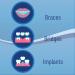 Threader Floss for Braces Bridges & Implants - 30 Count Pack of 3 | Easy & Effective Plaque Remover | On-The-Go Floss - Buy Online on GoSupps.com