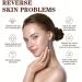 Anti Acne Face Cream Tea Tree Face Acne Gel Acne Scar Treatment Spot Cream for Acne Treatment and Spot Treatment Acne Cream Spot Treatment for Face Acne Scar Removal Cream Acne Moisturiser Face - Buy Online on GoSupps.com