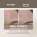 Everlit Silicone Scar Sheet | Medical Grade Skin Repair Strips for C-Section Acne Surgery | Soft Reusable Gel Tape | 1.6 x 60 Roll - Buy Online on GoSupps.com