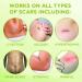 KELODA Scar & Keloid Removal Butter Stick with Menthol | Soothing Balm for Painful Scars & Keloids | Helps Heal Piercings & Burn Scars | with Cocoa Shea Butter & Essential Oils - Buy Online on GoSupps.com
