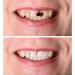 Zhirceke Silicone Cosmetic Veneer Teeth - Temporary Dentures for Couples | Comfortable & Ideal for Bad Teeth - Buy Online on GoSupps.com