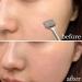 3 Blackhead Extractor Tool | Pimple Cleaning Tool Comedone Pimple Extractor Tool for Blackhead Whitehead Popping Zit Removing Nicything 3 Pcs a - Buy Online on GoSupps.com
