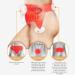 TPARIS Prostate Treatment Device Repair Men Body Function HD Touch Screen Natural Therapy Home Use for Urgency Urinary Incontinence Improves Health Promotes Sleep - Buy Online on GoSupps.com