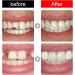 Tooth Filling Beads for Temporary Tooth Repair | Thermally Adhesive Fixing Beads for Broken Teeth | Perfect for Halloween Cosplay - Buy Online on GoSupps.com
