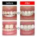 Tooth Repair Kit - Moldable Teething Ring Temporary Cavity Filling Denture Modification & Party Makeup | International Shipping - Buy Online on GoSupps.com