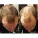 1BAG Hair Building Fibers Instant Hair Loss Treatment Color Powder Conceal Thinning Hair Add Volume For Both Men & Women(Black)  - Buy Online on GoSupps.com