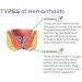 EXQST Heca Natural Herbal Hemorrhoid Capsules - Fast Relief (7 Capsules/Box) - Buy Online on GoSupps.com