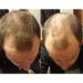 1BAG Hair Building Fibers - Instant Hair Loss Treatment for Men & Women | Dark Brown Color Powder to Conceal Thinning Hair & Add Volume - Buy Online on GoSupps.com