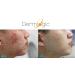 Acne Treatment Control Pads with Salicylic, Glycolic & Lactic Acid - Clears Pores, Oily Skin & Breakouts. Removes Dark Spots & Pimples - Buy Online on GoSupps.com
