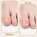 Nail Repair Patches Toenail Patches Ingrown Toenail Treatment Broken Nail Repair Toenail Stickers Toenail Corrector Patch Toe Nail Correct Stickers Comfortable Correction Patch Stickers For Toenail - Buy Online on GoSupps.com