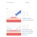 Blackhead Acne Pin Blemish Remover Tool | Easy Operation | ABS Material - Buy Online on GoSupps.com