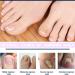 200 Pieces Ingrown Toenails Stickers Toenail Correction Patch Glue-Free Ingrown Curved Toenail Lifter Foot Care Treatment Pedicure Tool (A) - Buy Online on GoSupps.com