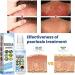 BIVOO Herbal Psoriasis Relief Spray | Vitiligo & Psoriasis Treatment | All Skin Types | 5pcs - Buy Online on GoSupps.com