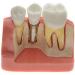 Samnuerly 4-Fold Dental Implant Crown Bridge Model - Compare Results for Patient Communication | International Shipping - Buy Online on GoSupps.com