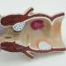 Humanly Rectal Hemorrhoid Lesions Anatomical Model Dilkpunkt Anal Anorectal - Buy Online on GoSupps.com