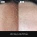 Comedones Soonsak Patch Super Mild - 50 Sheets for Gentle Sebum Removal | Innovative Skincare Technology - Buy Online on GoSupps.com