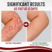 Dermax Psoriasis Treatment Spray 30ml - Soothe Skin, 5 Pack - Buy Online on GoSupps.com