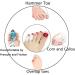 Fidgetfidget Silicone Toe Sleeves - Gel Toe Cap Cover for Corn & Blister Pain Relief | Bunion Care & Protection - Buy Online on GoSupps.com