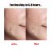 Hydrocolloid Acne Patches for Face | Effective Pimple Treatment | International Shipping - Buy Online on GoSupps.com