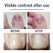 100PCS Ingrown Toe Nail Correction Sticker - Health Toenail Corrector Patch - Buy Online on GoSupps.com