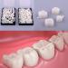 Tooloflife Temporary Tooth Crown - 70 Parts Box Realistic Provisional Dental Care for Front & Back Teeth (140 Pieces) | International Shipping Available - Buy Online on GoSupps.com