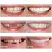 2 Pairs Veneers Dentures - Temporary Tooth Repair for Imperfect Teeth - Buy Online on GoSupps.com