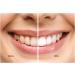 Purple Teeth Whitening Toothpaste - Effective Stain Removal & Colour Corrector for Brighten Smiles - Buy Online on GoSupps.com