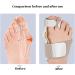 Zeetan Bale Toe Corrector - Adjustable Relief for Men & Women - Beige Left & Right Foot Support - Buy Online on GoSupps.com