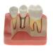 Samnuerly dental implant implementation model 4-way dental implant analysis-analysis-crown bridge demonstration model tooth crown roots for training removable