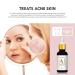 A1 Solution - Best Moisturizing Treatment for Acne Prone Skin | 30ml | Hydrate & Clear - Buy Online on GoSupps.com
