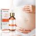 Stretch Mark Repair Cream - 20ml Bio Oil for Pregnancy Streaks & Scars | Fade & Soothe with Massage Set - Buy Online on GoSupps.com