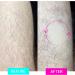 Xaydi Crystal Hair Eraser | Painless Hair Removal Epilator Device | Nano-Crystalline Technology | For Women & Men | Silver - Buy Online on GoSupps.com